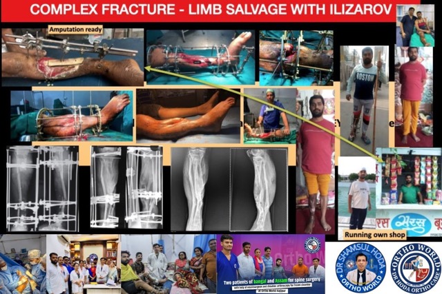 Ilizarov Limb Salvage for Complex Trauma 